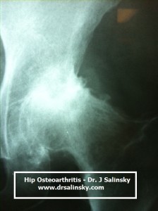 severe-hip-osteoarthritis-dr-salinsky