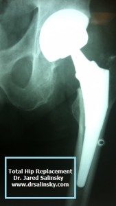 total-hip-replacement-dr-jared-salinsky